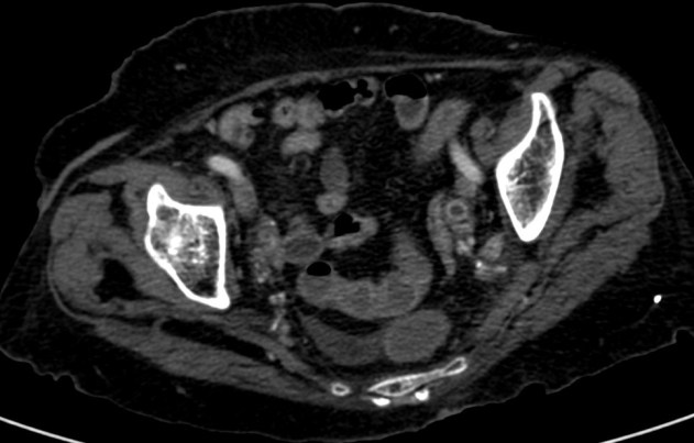 En este corte pélvico se observa un uréter dilatado con realce mural.