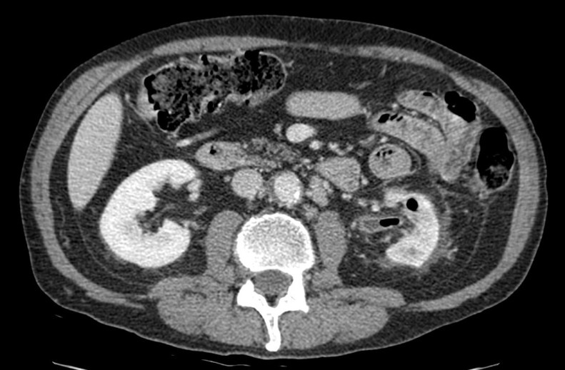 Corte axial. Se observa gas en el parénquima renal y sistema colector. Grado II