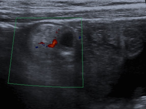 Con captación de señal Doppler color.