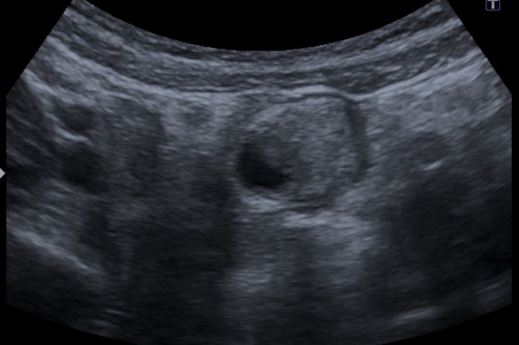 Se observa una imagen redondeada, de bordes engrosados e irregulares, con contenido quístico en su interior y p