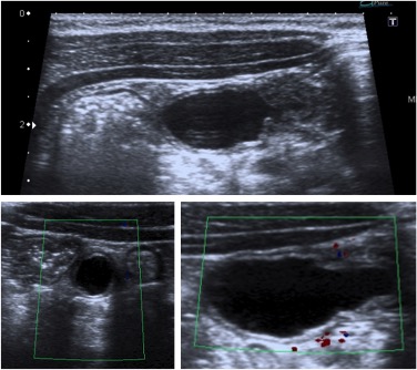 Quiste de duplicación. Colección anecogénica a nivel ileal que no se continúa con ningún asa intestinal, bien definida y sin señal Doppler Color.