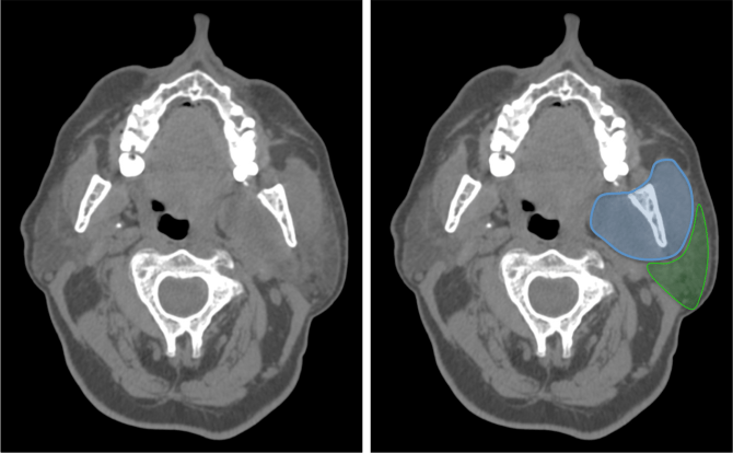 TC sin contraste. Para no incurrir en errores, Es importante estar familiarizados con densidad normal de la parótida, que debe ser baja comparada con los músculos y alta comparada con la grasa subcutánea tanto en TC sin y con contraste.