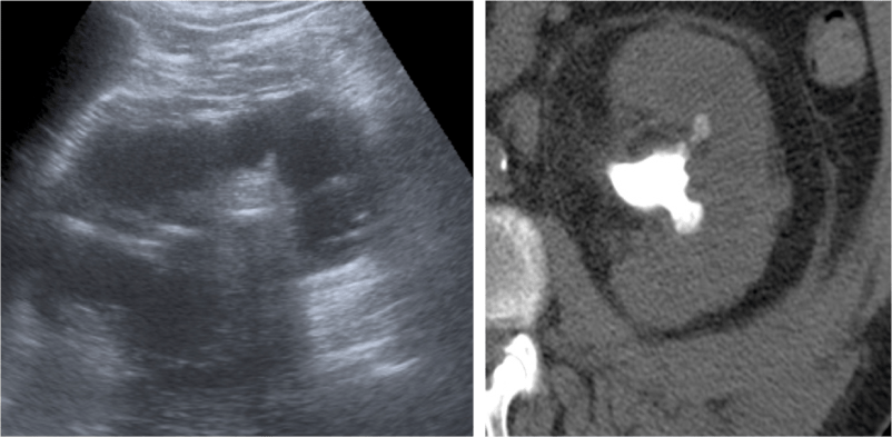 Ecografía y TC sin contraste correlativo. Riñón aumentado de tamaño con gran calcificación central compatible con cálculo coraliforme en pelvis renal.