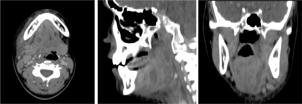 Otro caso similar. Las reconstrucciones son muy importantes para diferenciar entre espacio sublingual y submandibular.