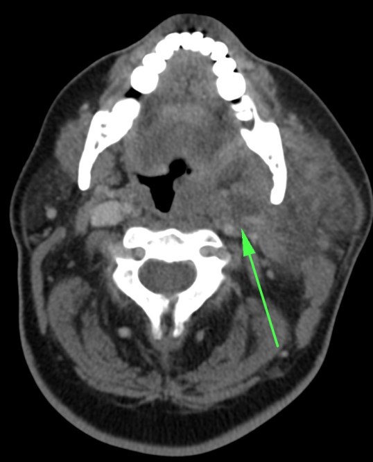 Gran infección cervical que afecta múltiples espacios. La flecha verde señala una colección hipodensa con realce periférico que afecta el espacio parafíngeo y la amígada izquierda, desviando dicho proceso la faringe hacia el lado contralateral.
