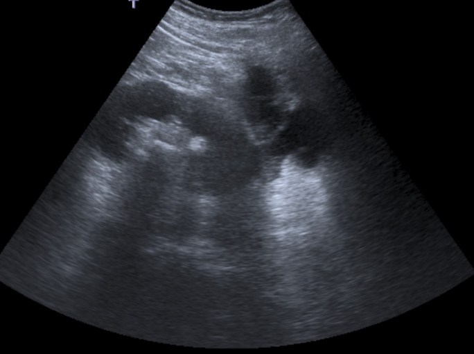Se observan hiperecogenicidades centreales con sombra acústica en la región central del riñón que pueden corresponder con litiasis.