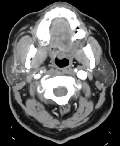 Las infecciones bacterianas suelen ser unilaterales: aumento del tamaño glandular y aumento de la densidad con afectación de la grasa adyacente. Abscesos. Pueden estar asociadas con sialotiasis.
