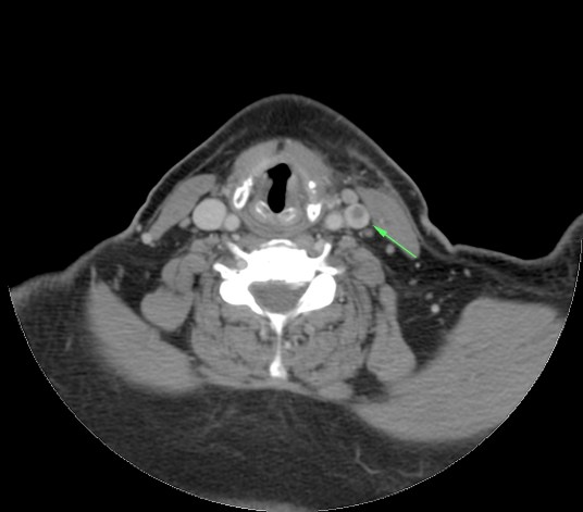 Defecto de repleción en vena yugular interna compatible con émbolo séptico.