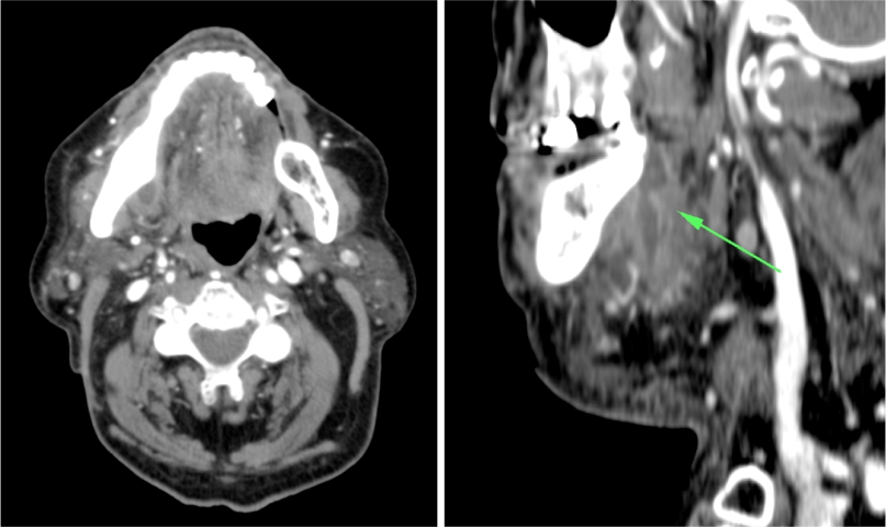 TC con contraste donde se evidencia una colección hipodensa con realce periférico compatible con absceso en el espacio submandibular. A la izquierda, reconstrucción sagital.