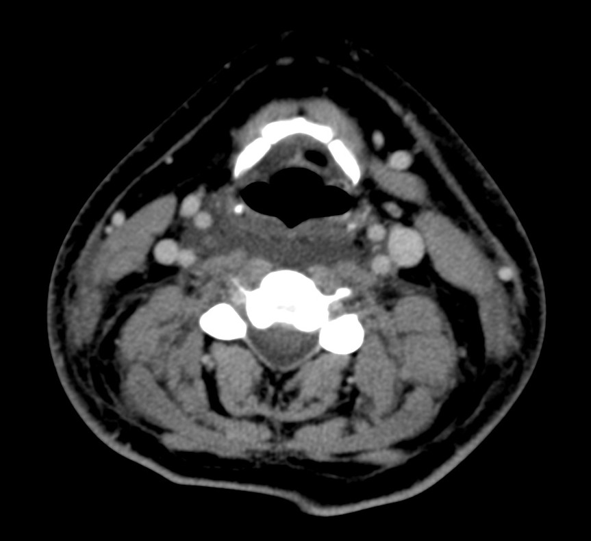 Edema de baja densidad inidicativo de afectación dell espacio retrofaringeo.