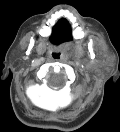 Parótida izquierda aumentada de tamaño e hiperdensa. Observa la contralateral.