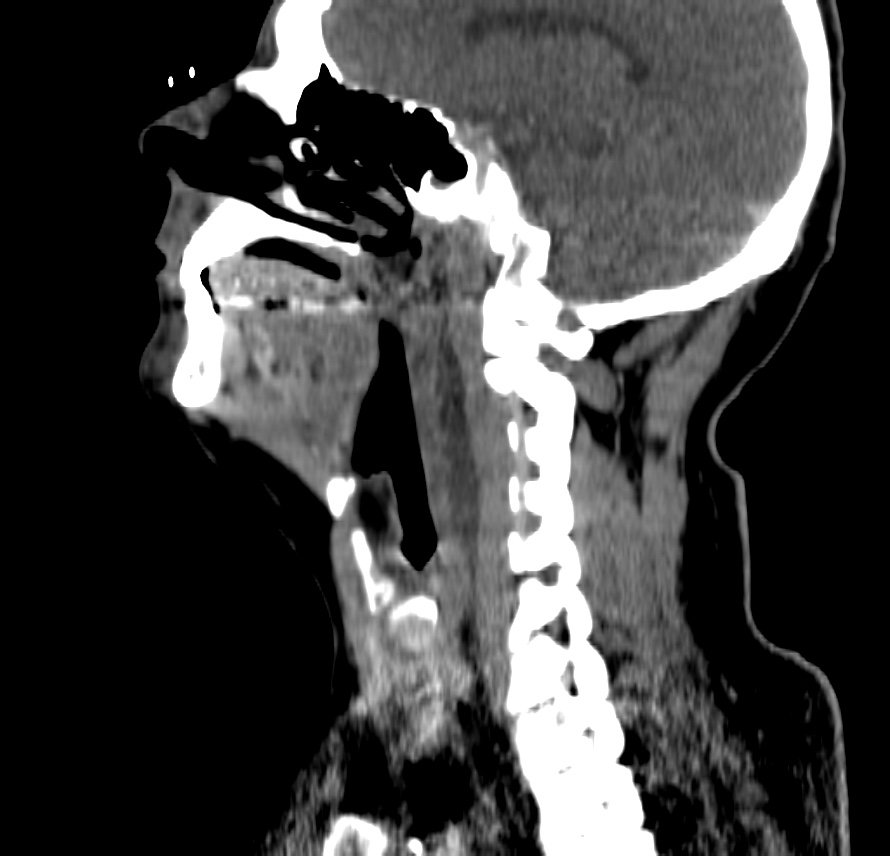 Espacio retrofaríngeo, mismo paciente. Debemos indicar el nivel en el cual el espacio retrofaríngeo vuelve a ser normal. En este caso, la colección persistía hasta nivel de C6.