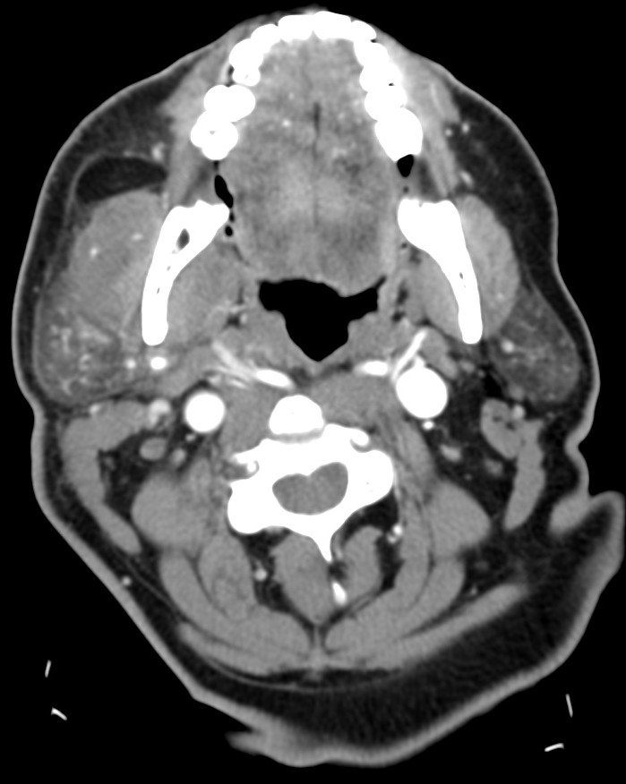 Paciente afectado de absceso submandibular (no se muestra) con repercusión al espacio masticador. Observar la miositis existente, sobre todo del músuculo masetero, con afectación de partes blandas y engrosamiento de