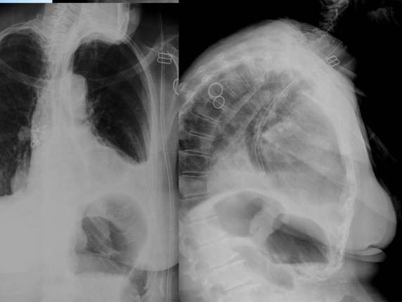 Se observa una imagen de doble burbuja en una paciente postoperada de reflujo por Funduplicatura de Nissen. Podría sugerir una volvulacion gástica y por ello hay que descartarla mediante la realización de una TC.