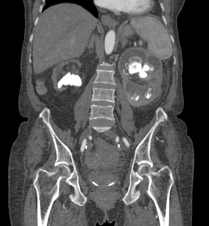 PNXG bilateral. Observar en este caso el riñón derecho atrófico.