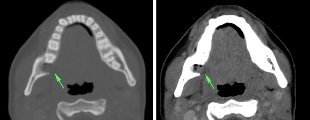 Ventana de hueso: es muy importante para identificar patología que afecte la mandíbula (abscesos, osteomileitis) y diferenciarla de otras entidades. En este caso vemos como la flecha señala un lugar de extracción de una pieza dentaria. En la imagen de la derecha no se observan abscesos ni otros signos inflamatorios sugieran un proceso infeccioso con destrucción ósea asociada.