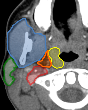 Naranja: espacio parafaríngeo. Amarillo: mucosa faringea/amíagala Rojo: espacio vascular. Azul: espacio masticador Verde: espacio parotídeo.