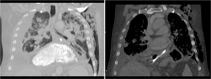 Se confirma la perforación con azul de metileno, de ahí es gas y las colecciones. Había salida de material desde estómago al tórax.