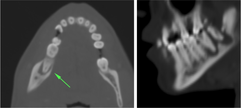 En el corte axial se observa una imagen anormal de 3er molar inferior (flecha), observando en la reconsturcción coronal las raíces dental No rodeadas des hueso sino "folantando" en una región hipondensa: Signo de las Racíces flotantes = patología endodental.