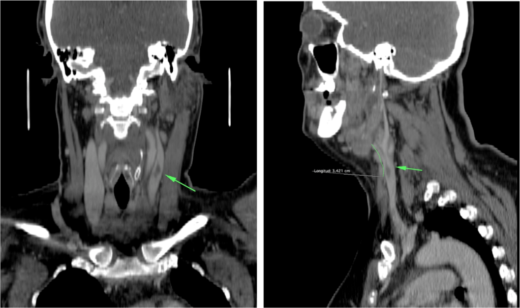 Reconsstrucciones cornal y sagital. El émbolo tiene una longitud de unos 3.4 cm aprox. En el estudio del tórax (no se muestra) no se evidenciaron alteraciones. 
