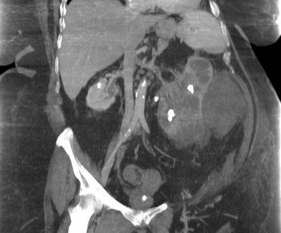 Reconstrucción coronal. Se observa una litiasis en el ureter izquierdo que está produciendo una ectasia retrógrada, motivo por el cual uno de los cálices puede haber rebentado y producido la colección extra renal.