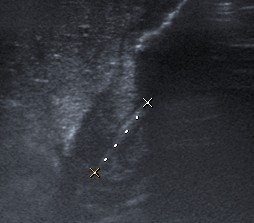 VisiónLongitudinal del píloro engrosado. Mide 18 mm aprox.