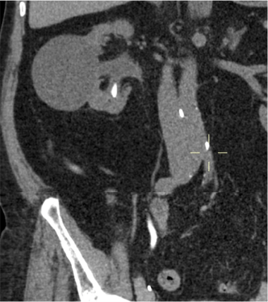 TC sin contraste donde se observa la dilatación obstructiva del sistema colector del tracto superior, quiste simple cortical, litiasis en polo inferior renal y uréter filiforme.