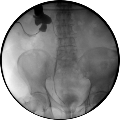 Imágen con contrate, obtenida por escopia durante la realización de la nefrostomía percutánea terapéutica donde se correlacionan los hallazgos de la TC.