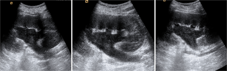 Debis ecogénico en el interior del sistema colector.