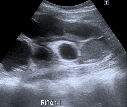Material ecogénico en el interior del sistema colector con niveles líquido-líquido.