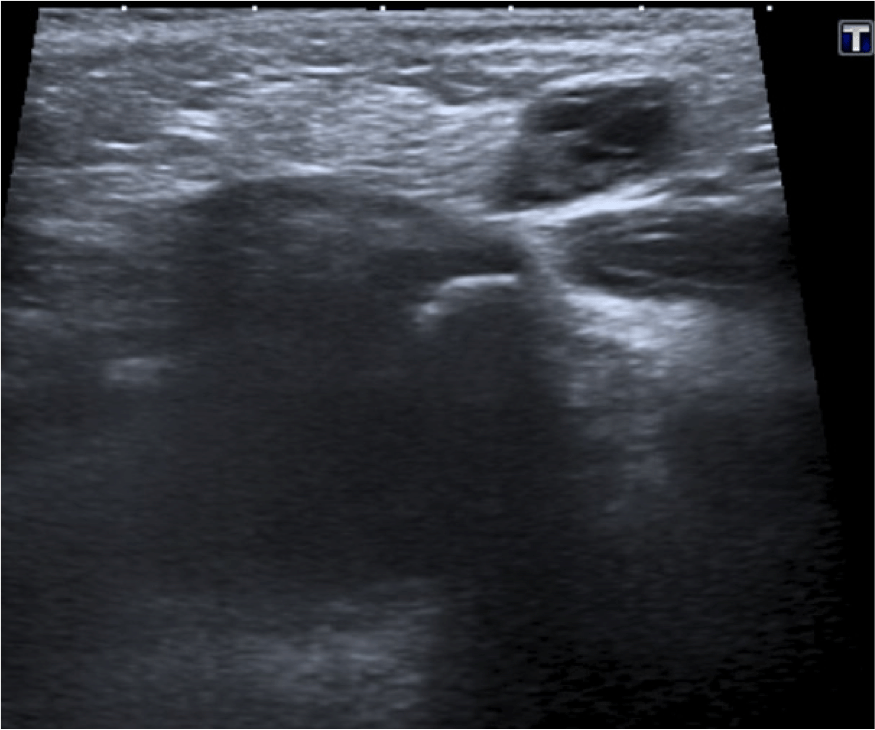 Se obser va la sínfisis del puvis y una masa con quístes en su interior por fuera de la pared abdominal.