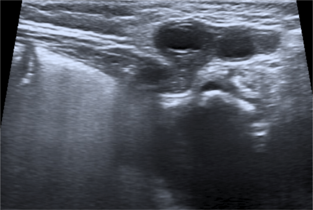 Se observa como el ovario se hernia a traves de la pared abdominal. Ovario presentaba captación de flujo Doppler color (no se muestra en la imagen).