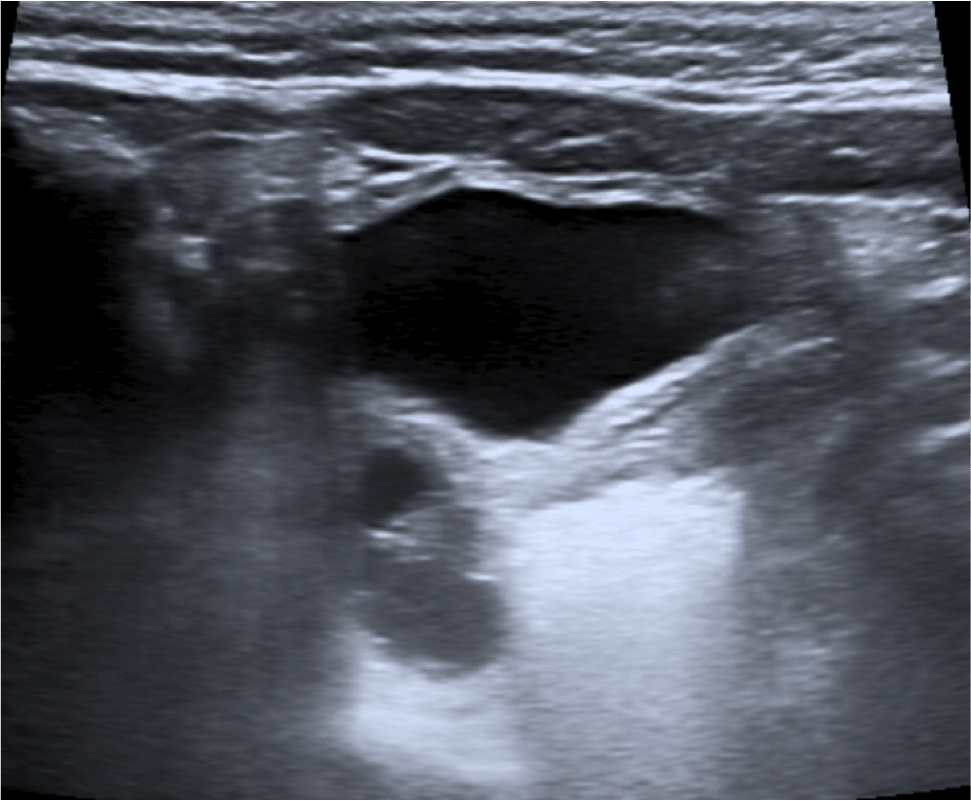 Se observa la vejiga a media repleción sin alteraciones murales ni endoluminales. Adyacente a la misma se observa el ovario derecho. No es visible el ovario izquierdo.