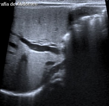 No se observa la vesícula biliar en este corte intercostal.