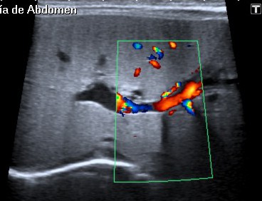 Dicha estructra no tiene captación Doppler color.