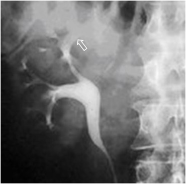 Fuente: Dr Navarro Sanchis - album de signos radiológicos.com pérdida de visualización de uno o más cálices. Este signo corresponde a un proceso renal que provoca infiltración y obliteración de uno o más cálices. En la imagen vemos que el cáliz más apical está ausente, observándose el infundíbulo amputado (flecha). El diagnóstico diferencial de este signo incluye cuadros inflamatorios (especialmente tuberculosis y eventualmente pielonefritis aguda), carcinoma renal, estenosis infundular secundaria a a traumatismo o litiasis, contusión renal y falta de relleno del cáliz por cuestiones técnicas.