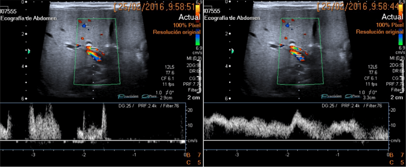 Captación Doppler color de vena porta y arteria hepática, la cual estaba aumentada de calibre.