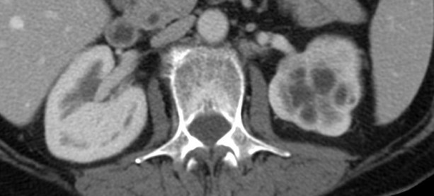 Se observa el riñón izquierdo con con alteración de su morfología y reducción del espesor cortical. El nefrograma del RI es más debil que el contralateral con zonas más hipodenas junto con otras de aspecto quístico.