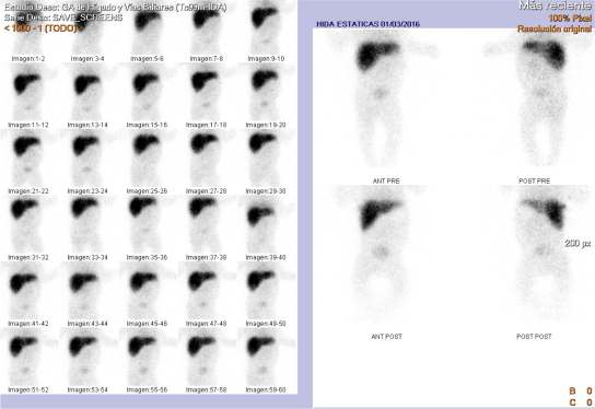 No se observa paso de trazador al árbol biliar ni duodeno.