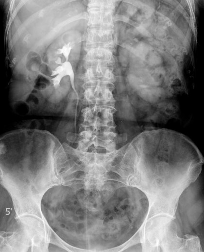 Anulación funcional del riñón izquierdo