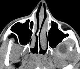 SE observa un absceso que oblitera la almohadilla grasa retromandibular. En este caso es muy evidente, pero ante celulitis o afectaciónes inflamatorias incipientes hay que estar antento a dicho hallazgo, ya que la obliteración o falta de definición de la almohadilla grasa nos puede ayudar a diagnosticar patología en una fase más precoz.