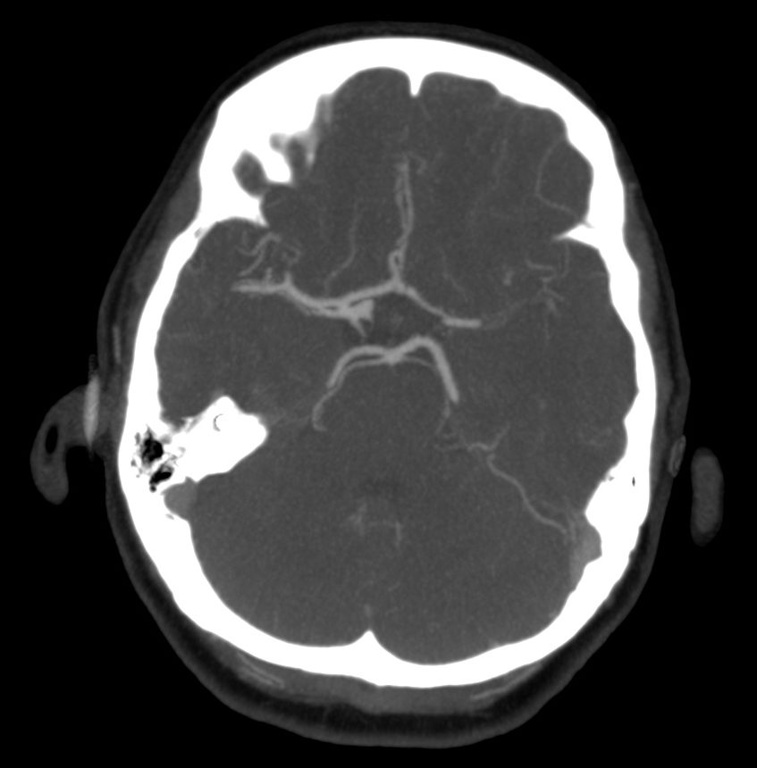 Se observa una oclusión de la ACM izquierda.