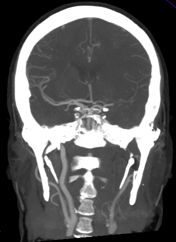 Existe una obstrucción en Tandem: oclusión de la ACI y ACM izquierdas.