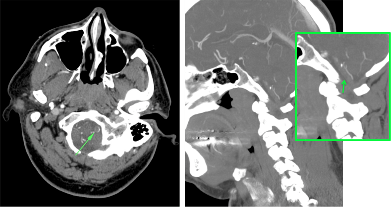 Trombosis en la arteria vertebral. Se observa falta de captación de contraste y engrosamiento arteria ocupado por material de 3-40 UH en su interior.