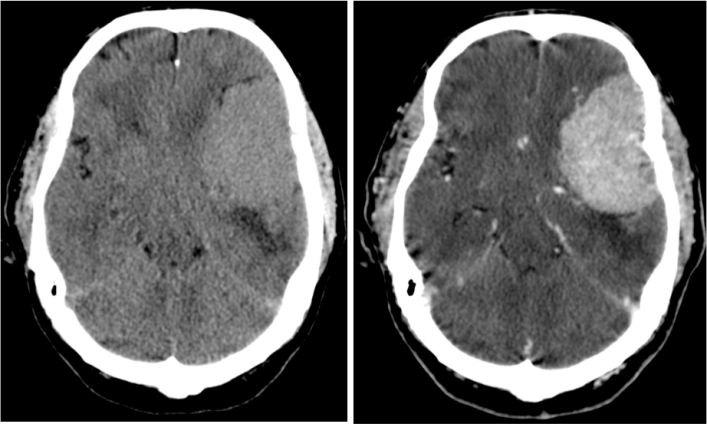 Meningioma de gran tamaño frontoparietotemporal izquierdo. Es ligeramente hiperdensa con respecto al parénquima adyacente. Asocia edema vasogénico perilesional y produce efecto masa. Tras administración de contraste se observa un realce intenso homogéneo.
