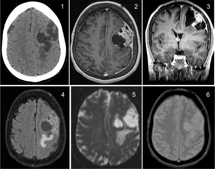 1) TC sin contraste se observa una lesión ocupante de espacio con áreas quisticas. Asocia deedema vasogénico. 2) y 3) En la RM con contraste vemos como la lesión realza con áreas quisitcas en su interior. Tiene una base de implantación periférica con engrosamiento y desplza estructuras centralmente. 4) T2-FLAIR