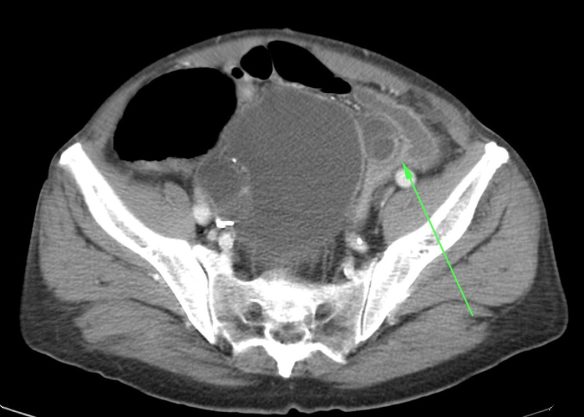 La flecha verde señala el cambio de calibre anterógrado a la invaginación.