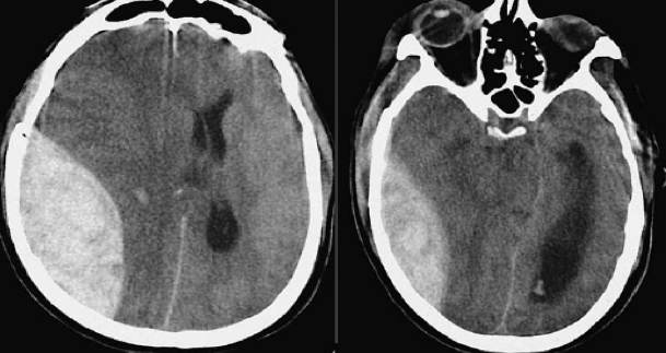 Epidural tempooparietal con marcado efecto masa con colapso ventriulo derecho y dilatación contralateral herniacion subfalcina. Herniación uncal