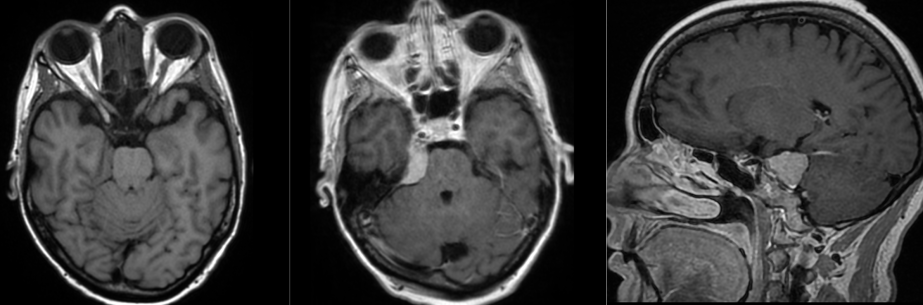 Meningioma del angulo pontocerebeloso.
