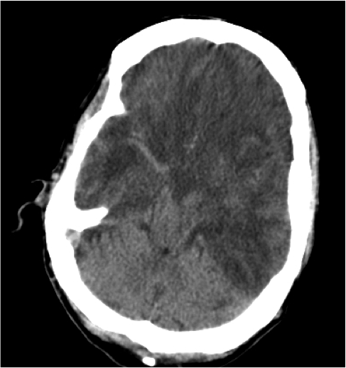 Signo del cerebelo blanco: 